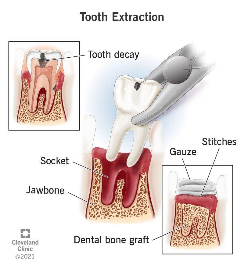 Tooth Extractions