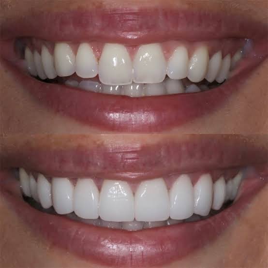 Teeth Reshaping & Contouring