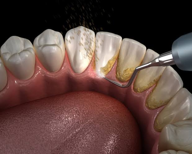 Teeth Cleaning & Scaling